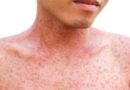Skin rash with red spots on a person's neck and chest.