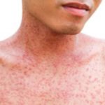 Skin rash with red spots on a person's neck and chest.