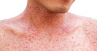 Skin rash with red spots on a person's neck and chest.